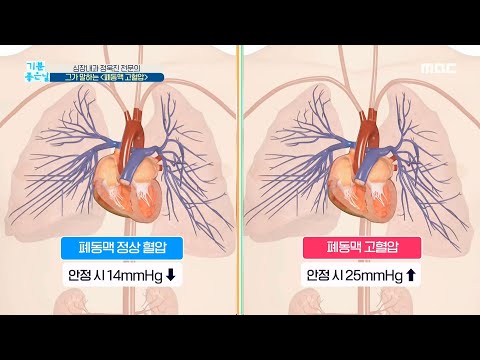 [기분 좋은 날] 심장내과 정욱진 전문의, 그가 말하는 ＜폐동맥 고혈압＞ MBC 200929 방송